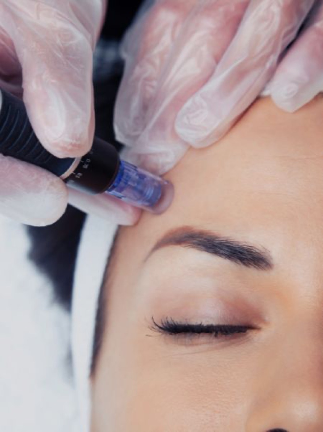 Microneedling bei Kosmetikstudio Ringberg, natürliches Lifting